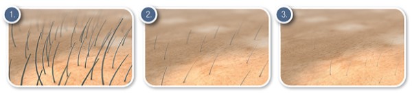 Darstellung von professioneller Haarwuchsreduktion mit EpilaDerm über die Zeit